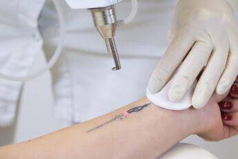 laser-tattoo-removal